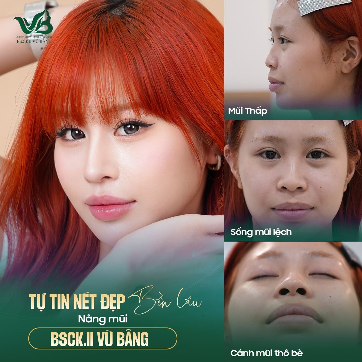 Before & After - Nâng mũi